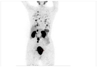 Pre-therapy PSMA Scan with disease in Prostate Gland