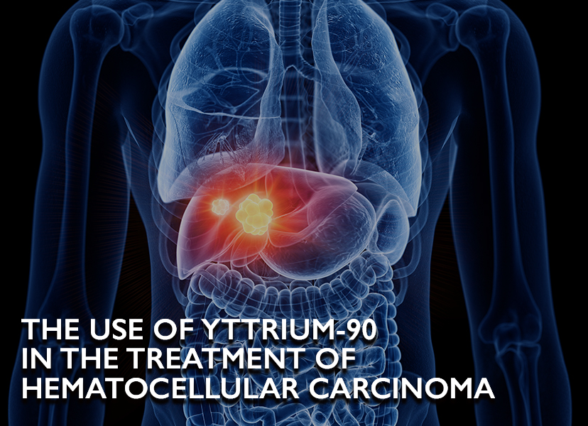 Use of Yttrium 90 (Y-90) and its effects