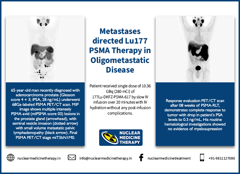 Metastasis directed Lu-177 PSMA Therapy in Prostate Cancer Patients with Oligometastatic Disease