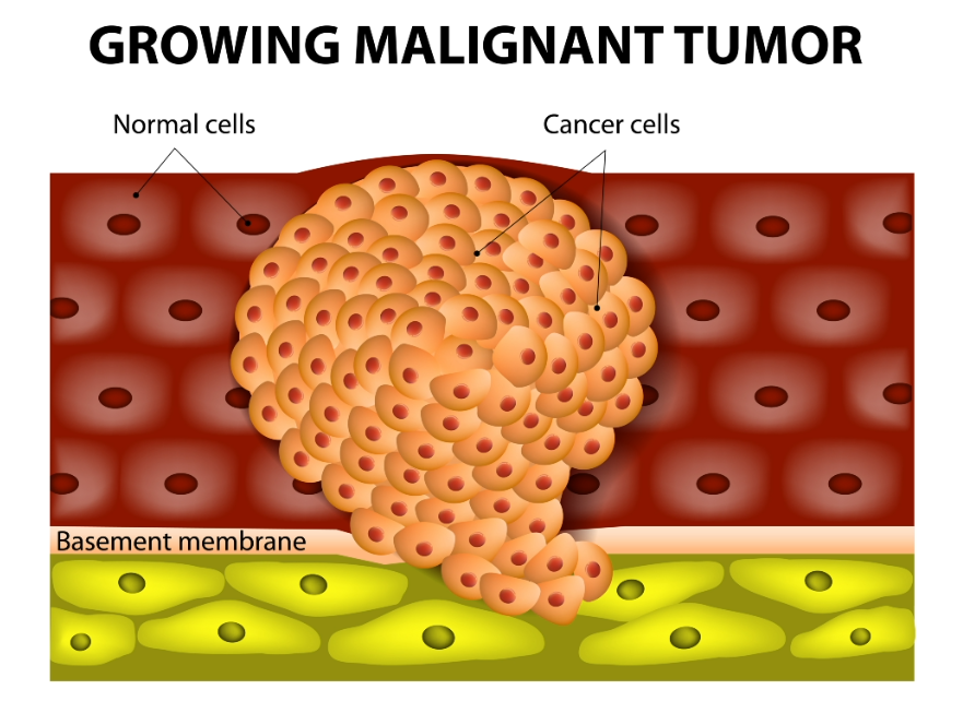 growing-malignant-tumor
