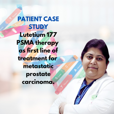 Lutetium 177 PSMA Therapy as the first line of treatment for Metastatic Prostate Carcinoma